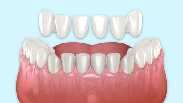 Porcelain veneers