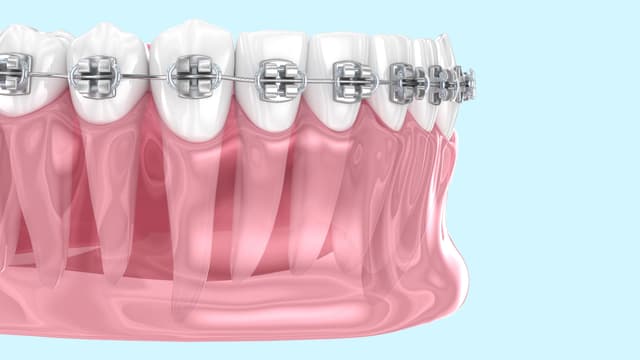 Braces