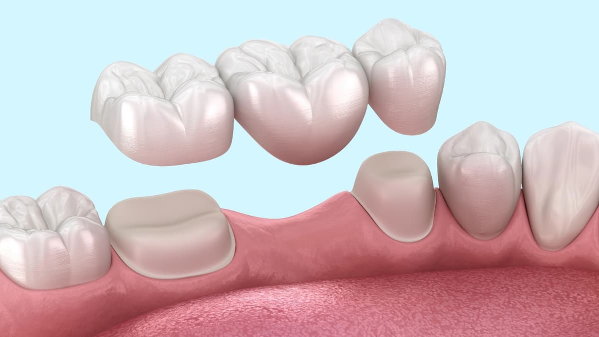 Dental bridges