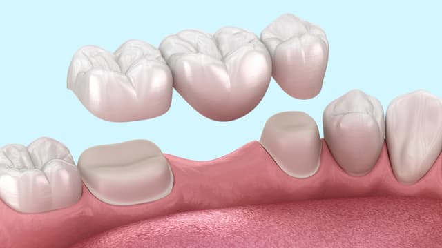 Dental bridges