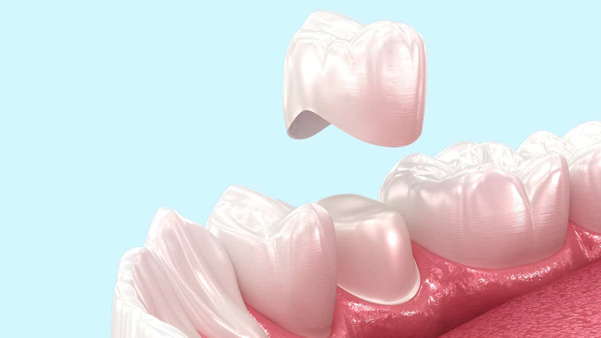 Dental crowns