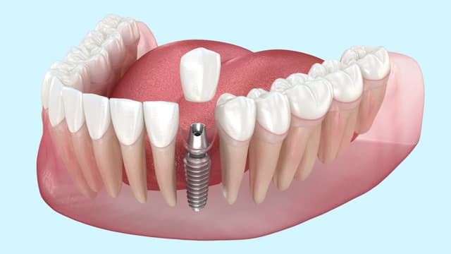 Dental Implants