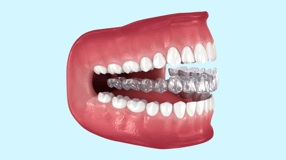 Invisalign