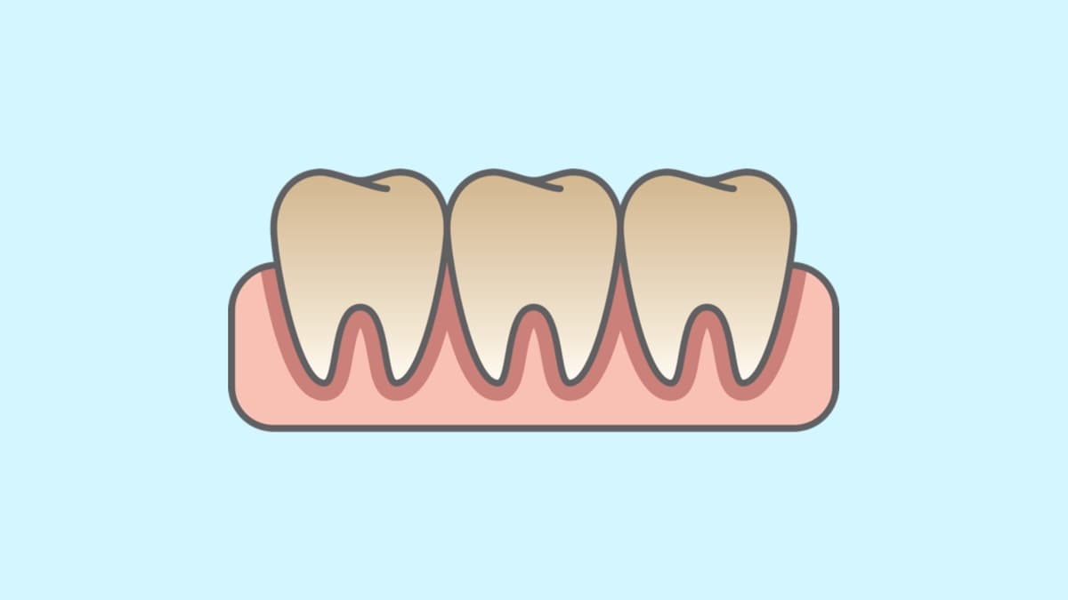 Discoloured Teeth