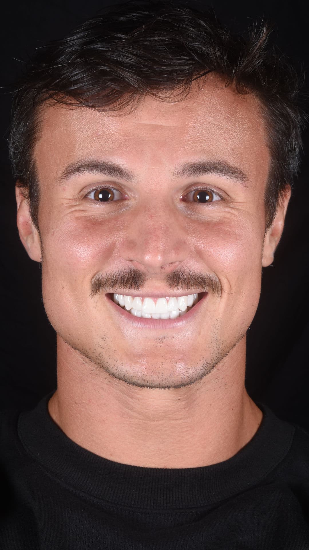 What Are Snap-On Veneers and How Do They Work?