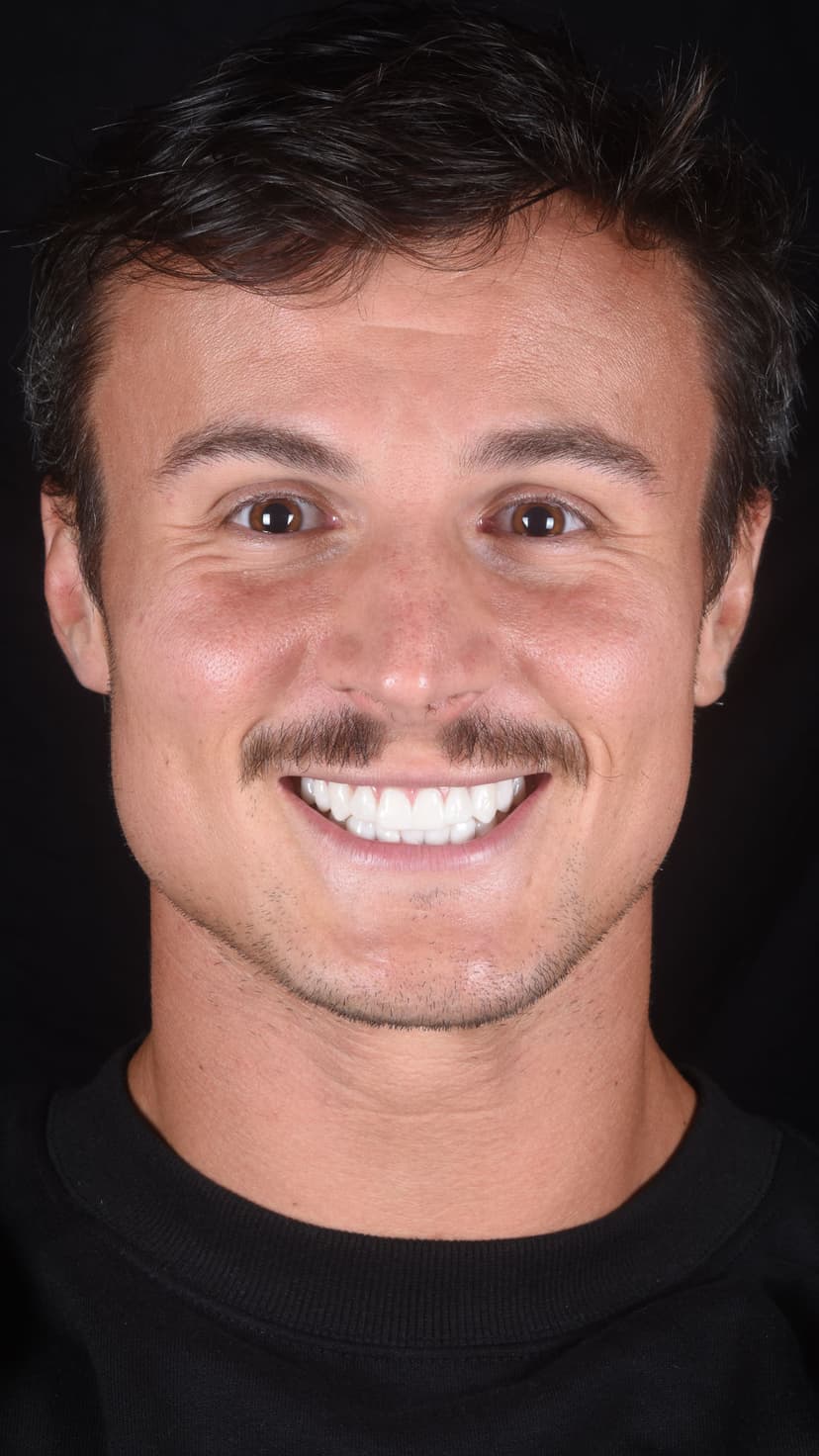 What Are Snap-On Veneers and How Do They Work?