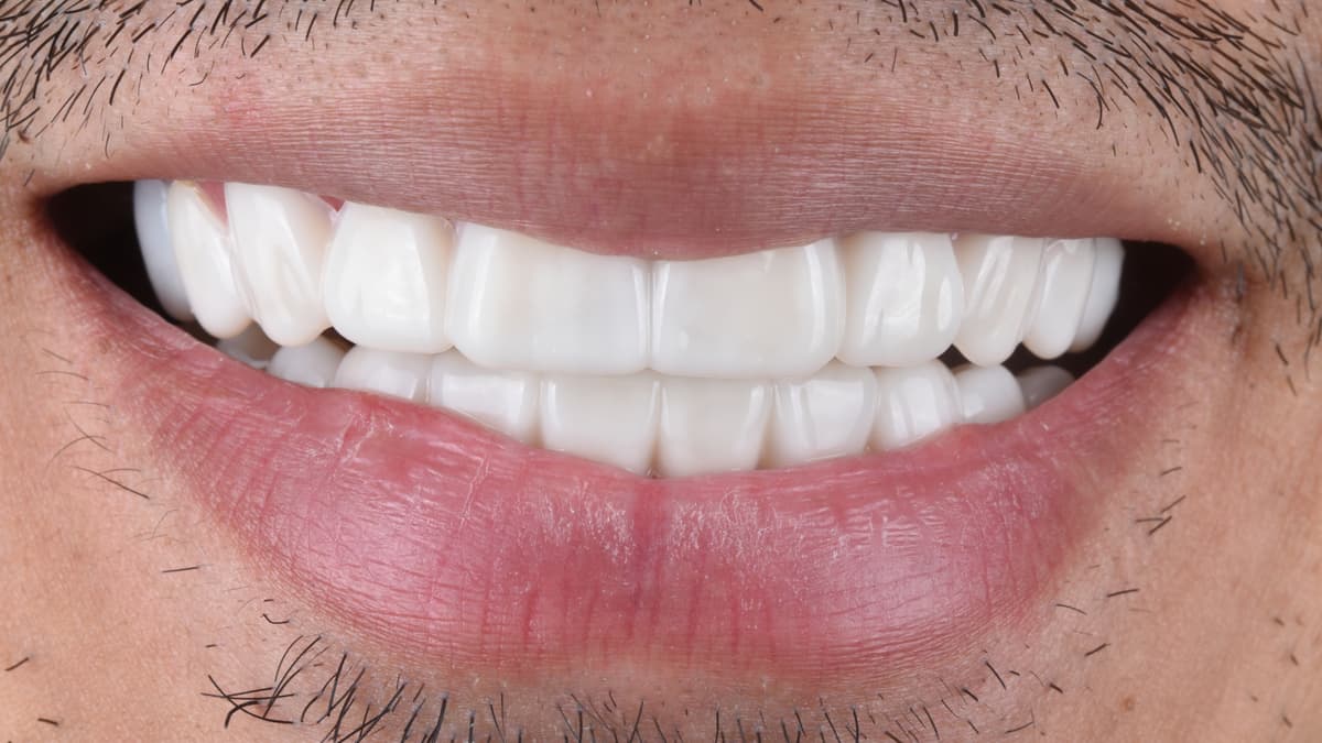 How to Care for Your Snap-On Veneers