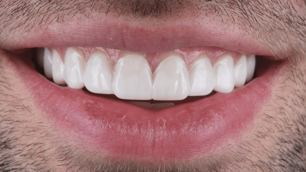 The Benefits of Choosing Snap-On Veneers