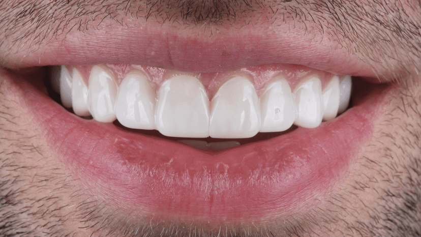 The Benefits of Choosing Snap-On Veneers