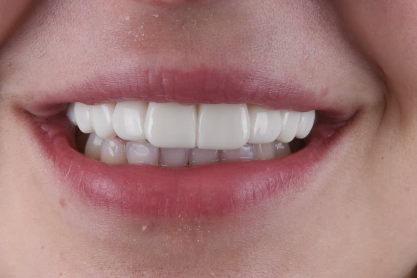 Why More People in the UK Are Choosing Snap-On Veneers