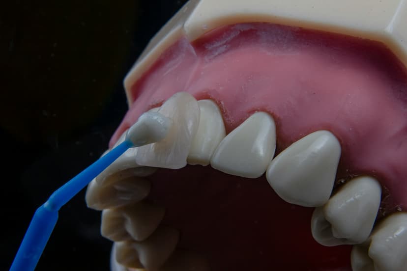Snap-On Veneers vs Traditional Veneers